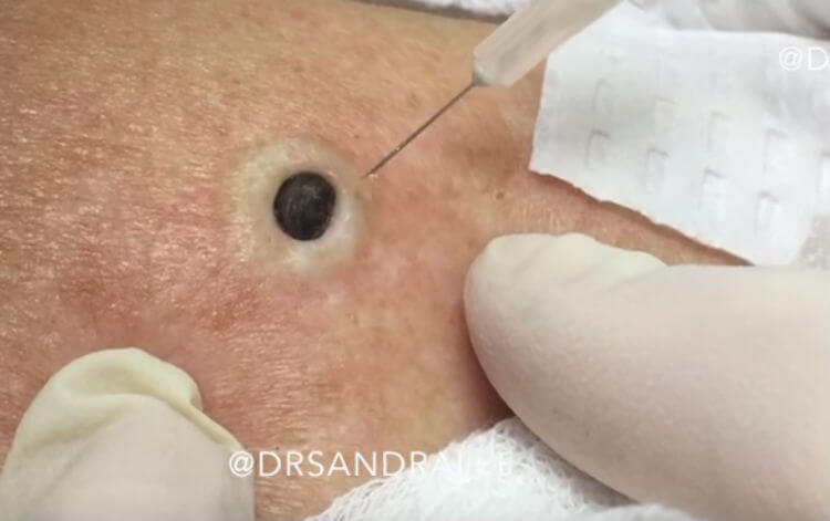 For Years She Thought It Was Just A Mole Then Her Doctor