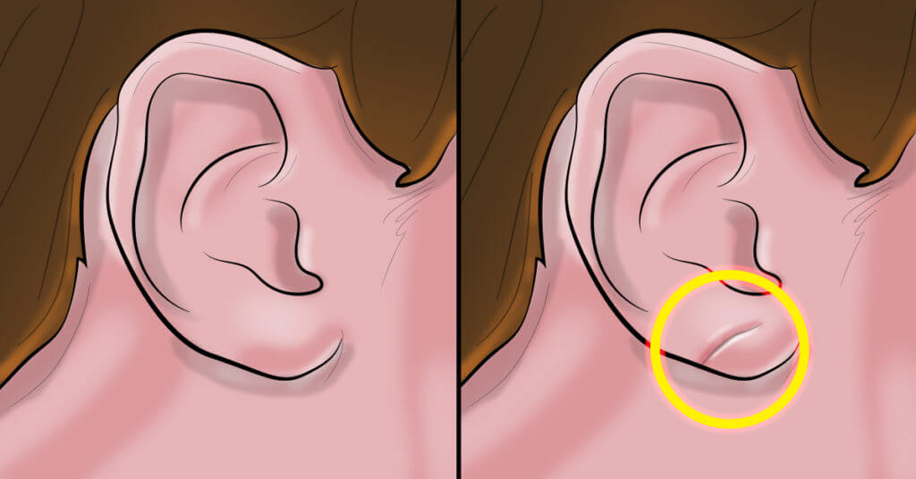 not-everyone-has-this-crease-on-their-ear-but-if-you-do-here-s-what-it