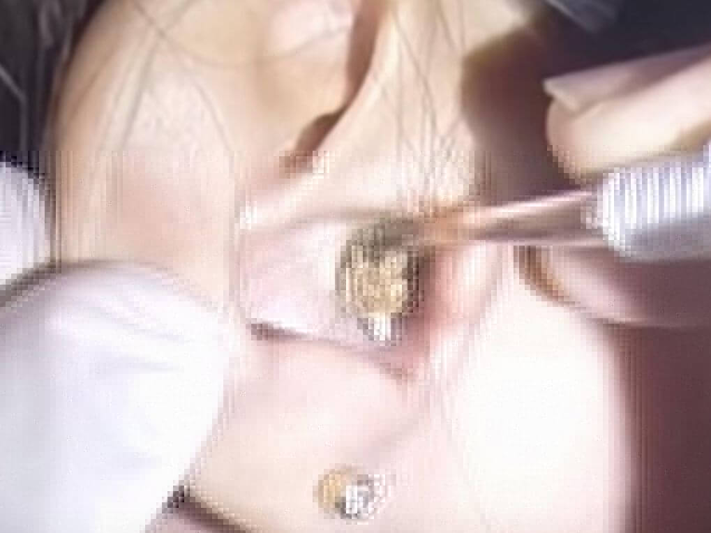 Eliminating Huge Amount Of Earwax