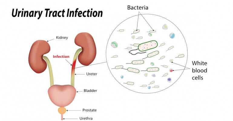 how-to-naturally-heal-urinary-tract-infection_img0089