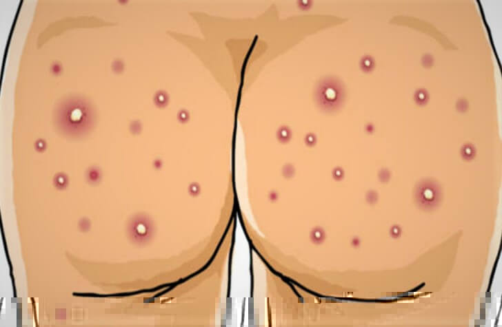 How To Get Rid Of The Acne on Your Butt