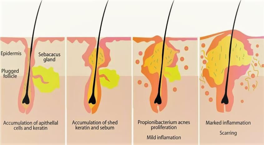 What Happens To A Pimple After You Pop It