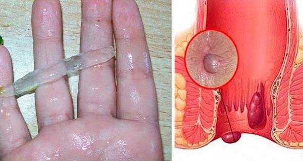 Remedy To Cure Hemorrhoids