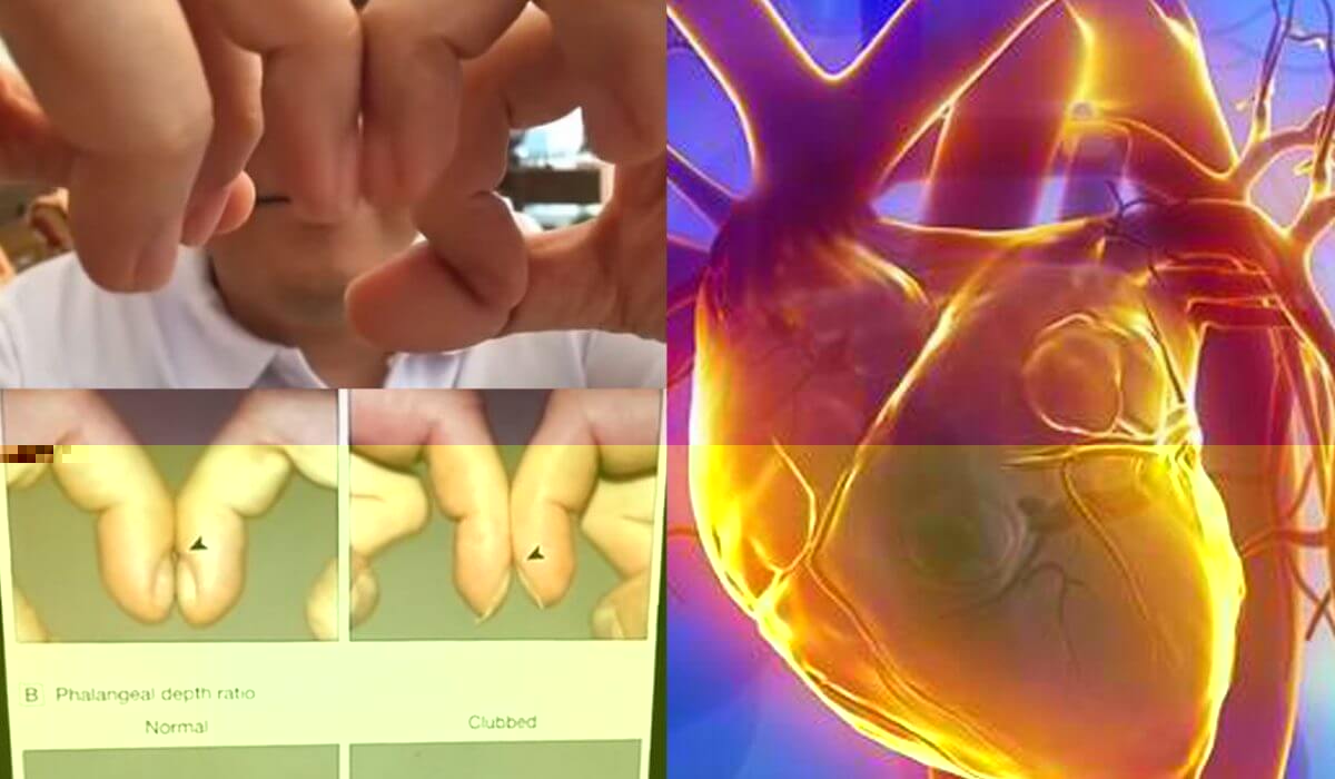Check Your Fingers and Fingernails To Find Out If You Have Heart